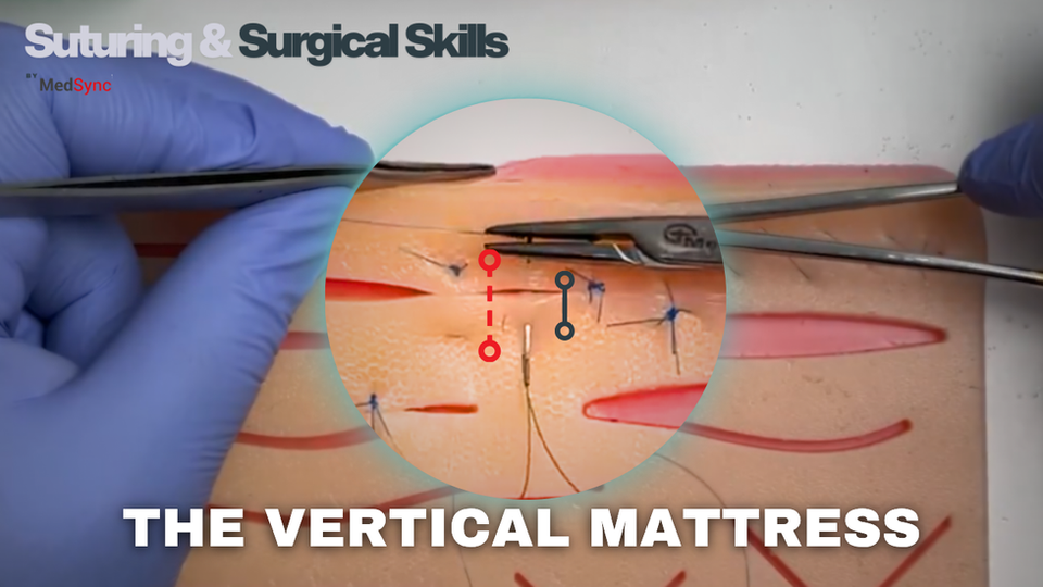 Vertical Mattress Suture